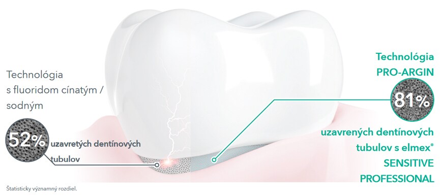 Vynikajúci uzáver dentínových tubulov vs. konkurenčná technológia
