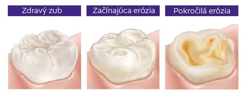 Erózia